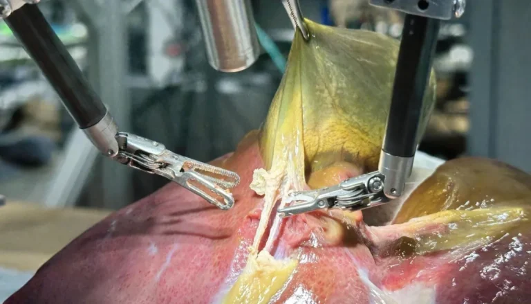 Robô com IA realiza cirurgia autônoma e redefine o futuro da medicina 1 robot surgery procedure e1752800997578.webp